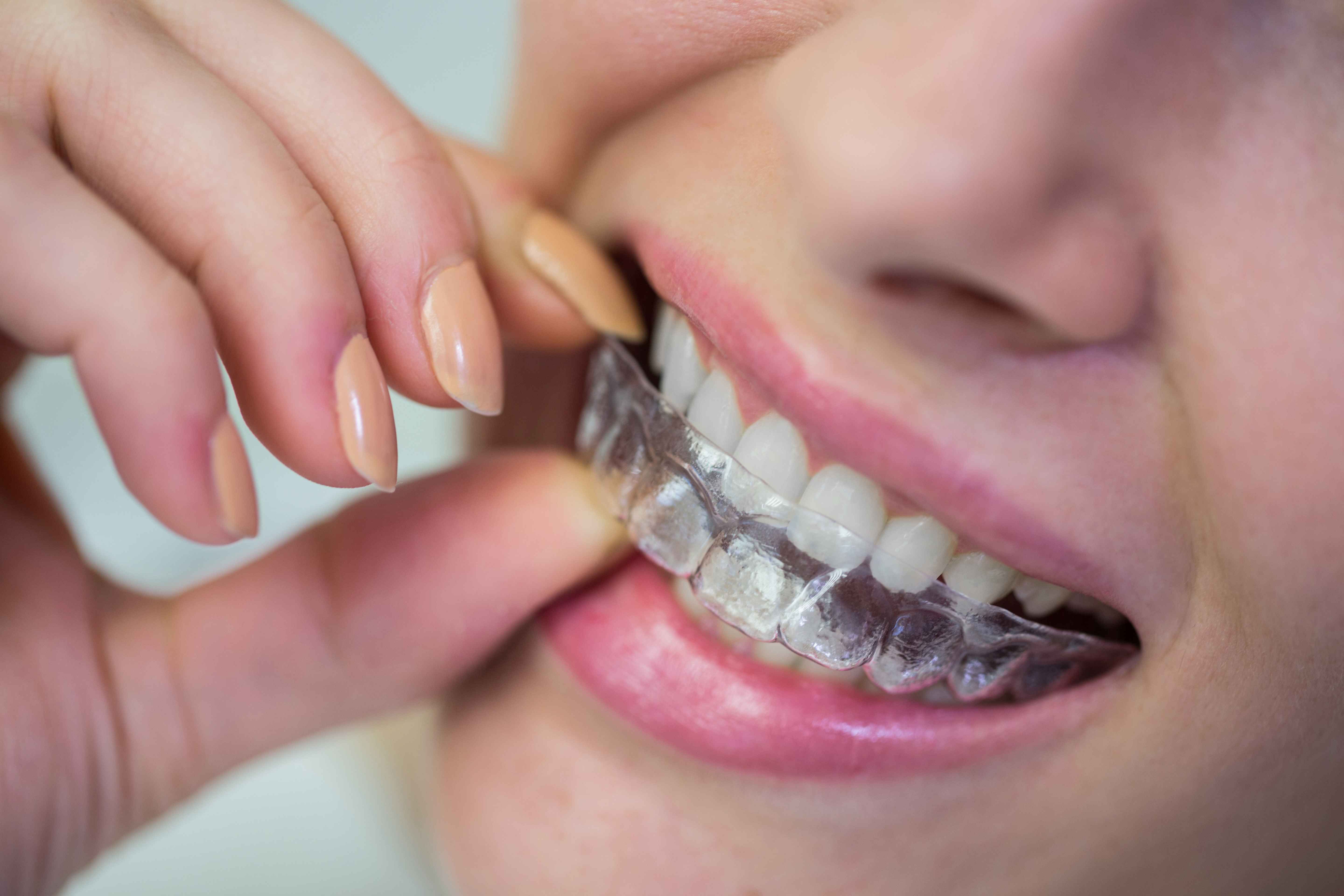 What Are Braces & Aligners?