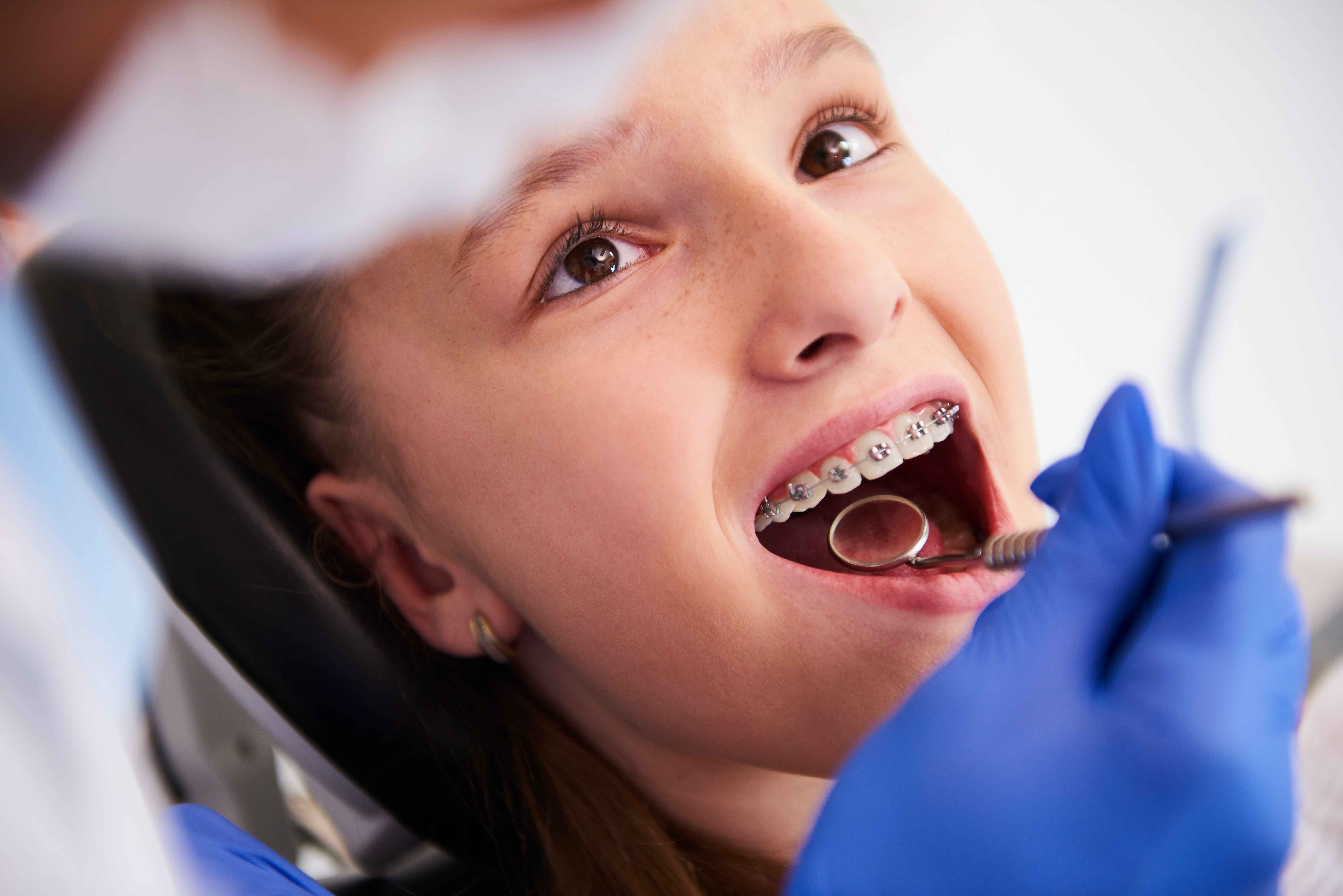 Common Braces & Aligners Procedures