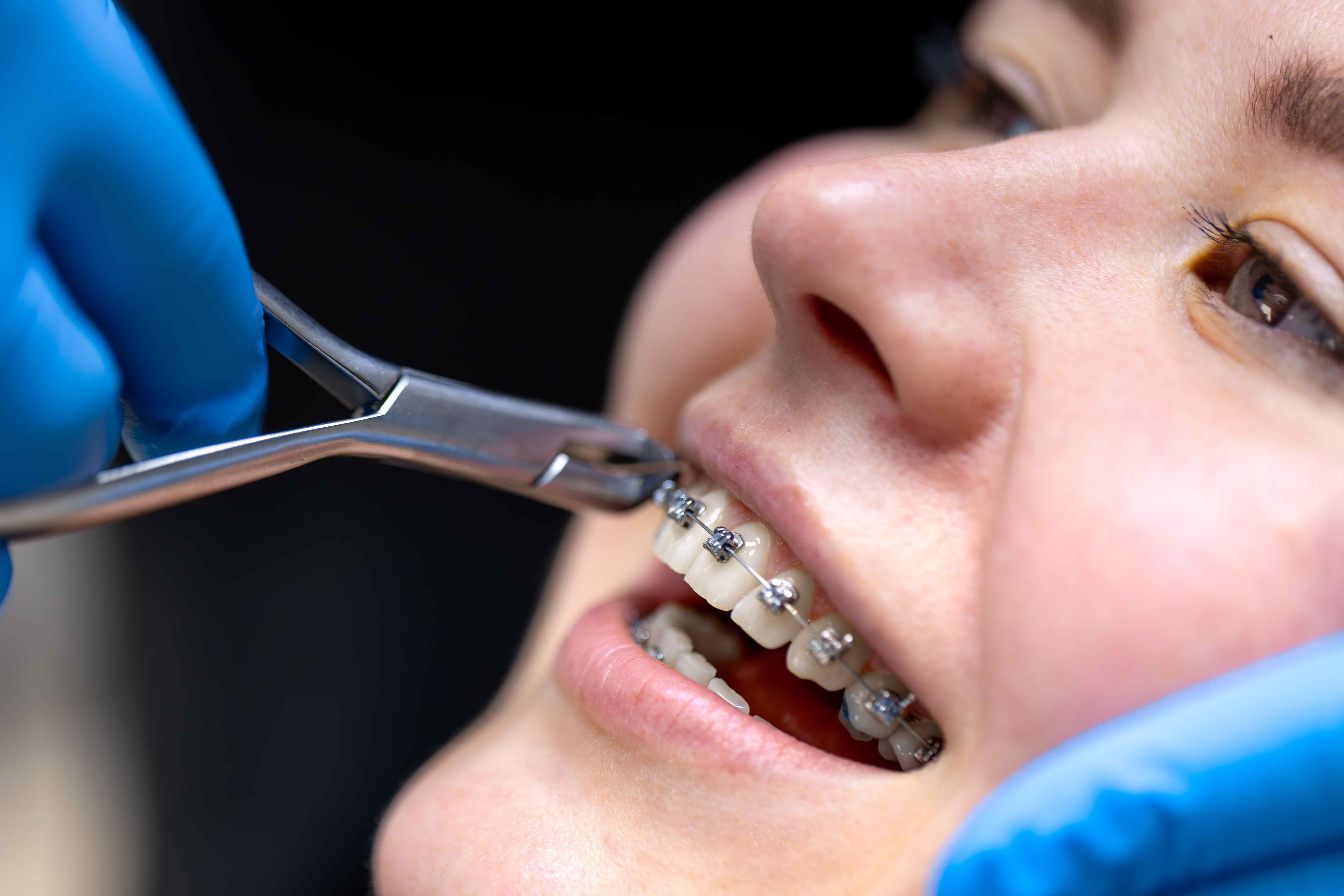 What to Expect During the Braces & Aligners Process