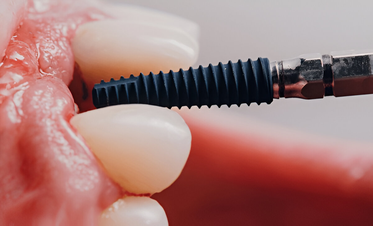 What are Dental Implants?