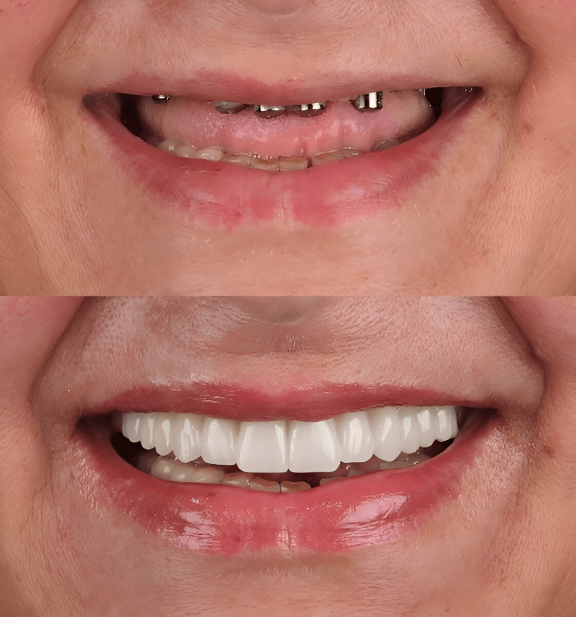 Benefits of Dental Implants