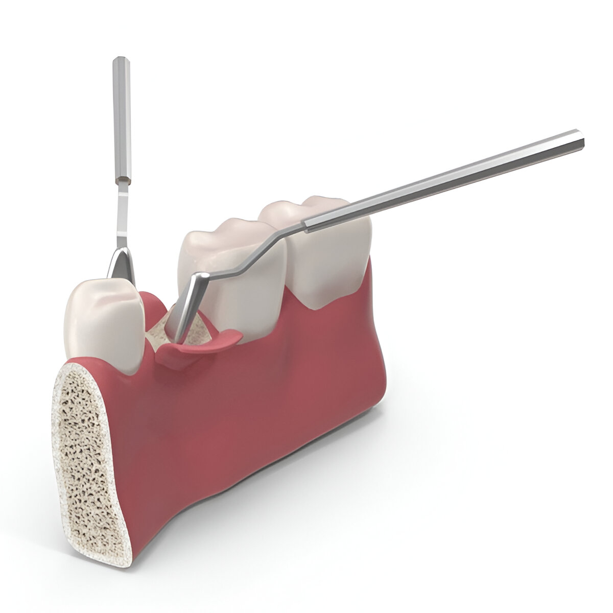 Who Needs Dental Implants?