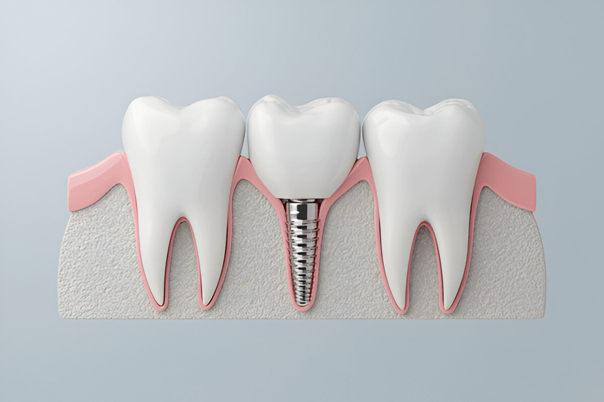 Common Dental Implant Procedures