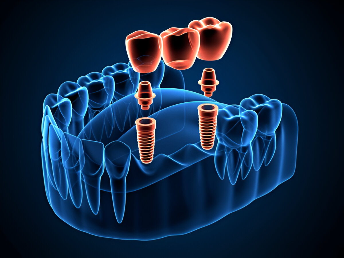 What to Expect During the Dental Implant Process