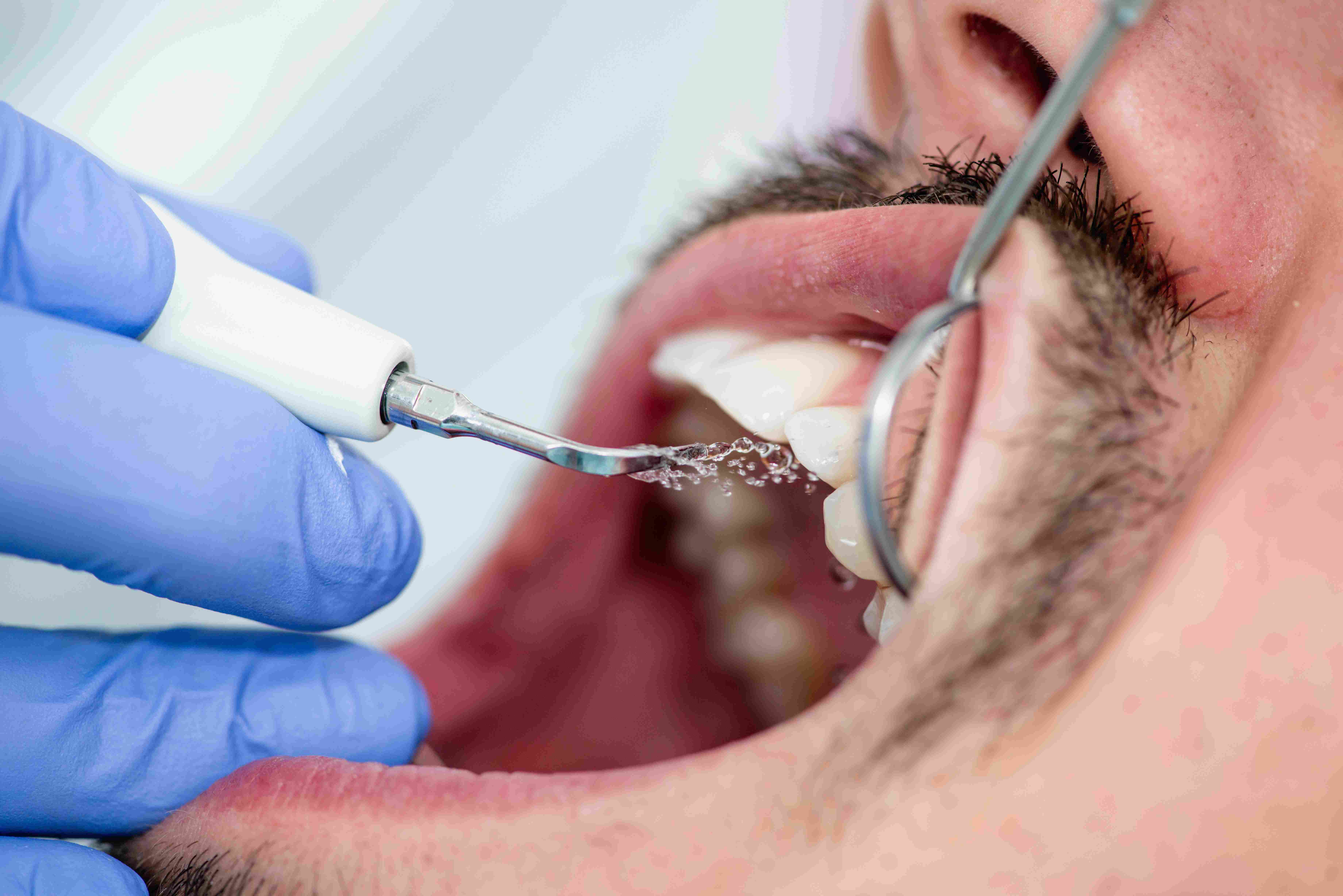 Scaling & Fillings