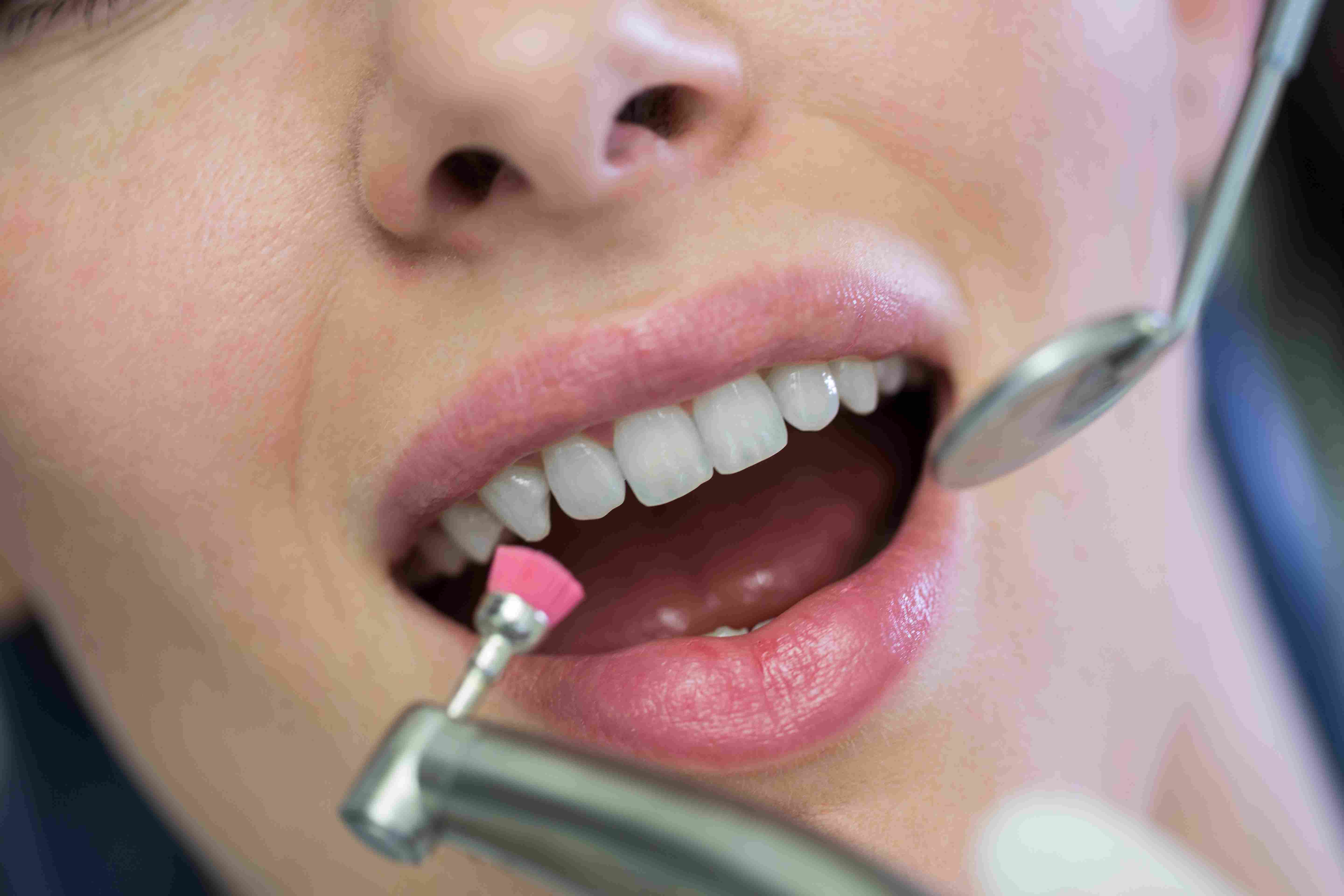 Who Needs Scaling & Fillings?