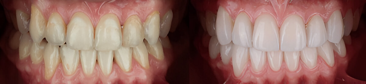 Teeth Whitening