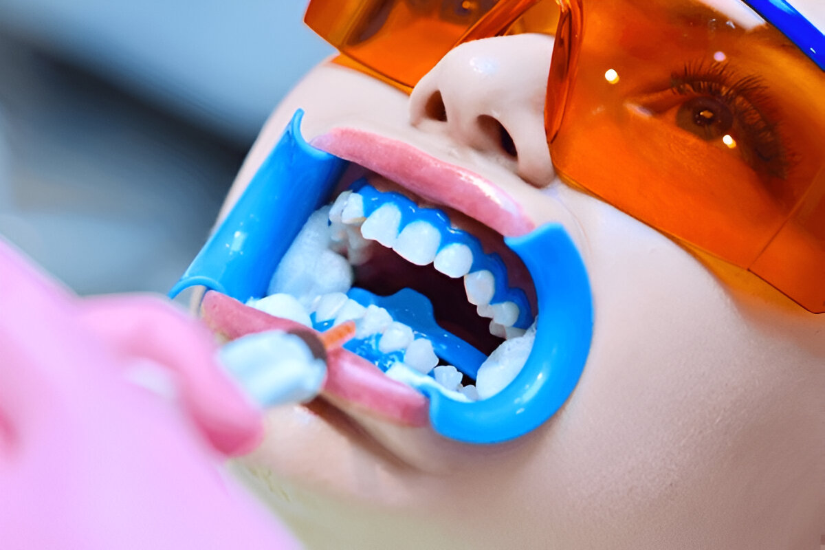 What to Expect During the Whitening Procedure