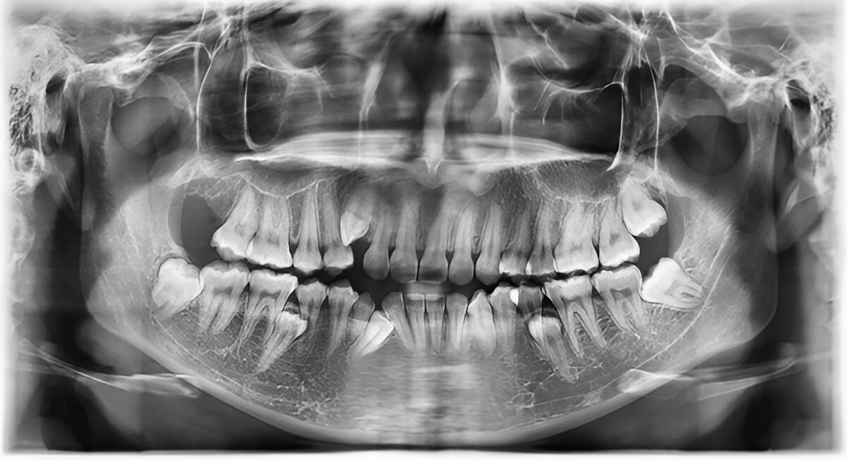 Minor Dental Surgeries