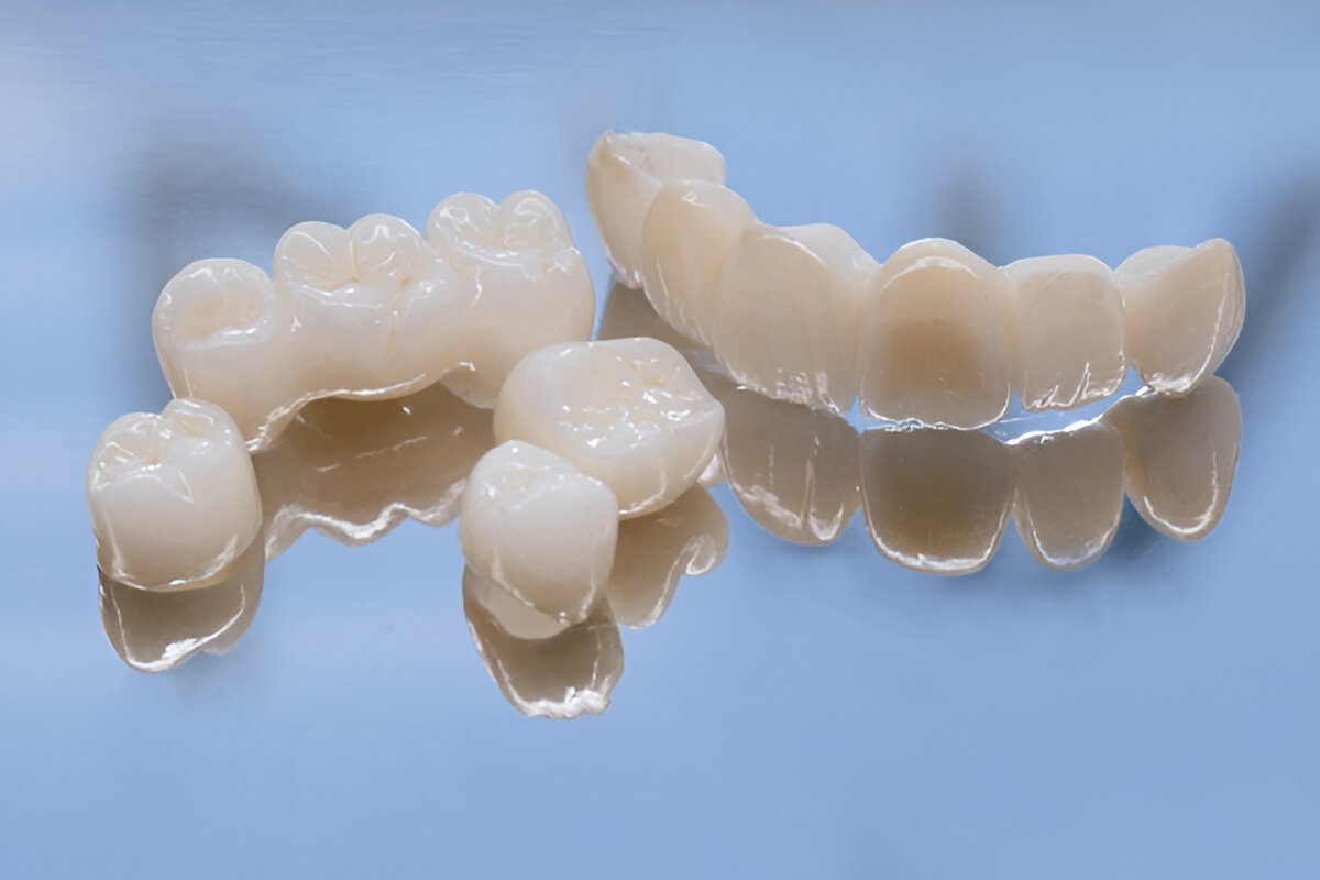 Common Dental Crown & Bridge Procedures