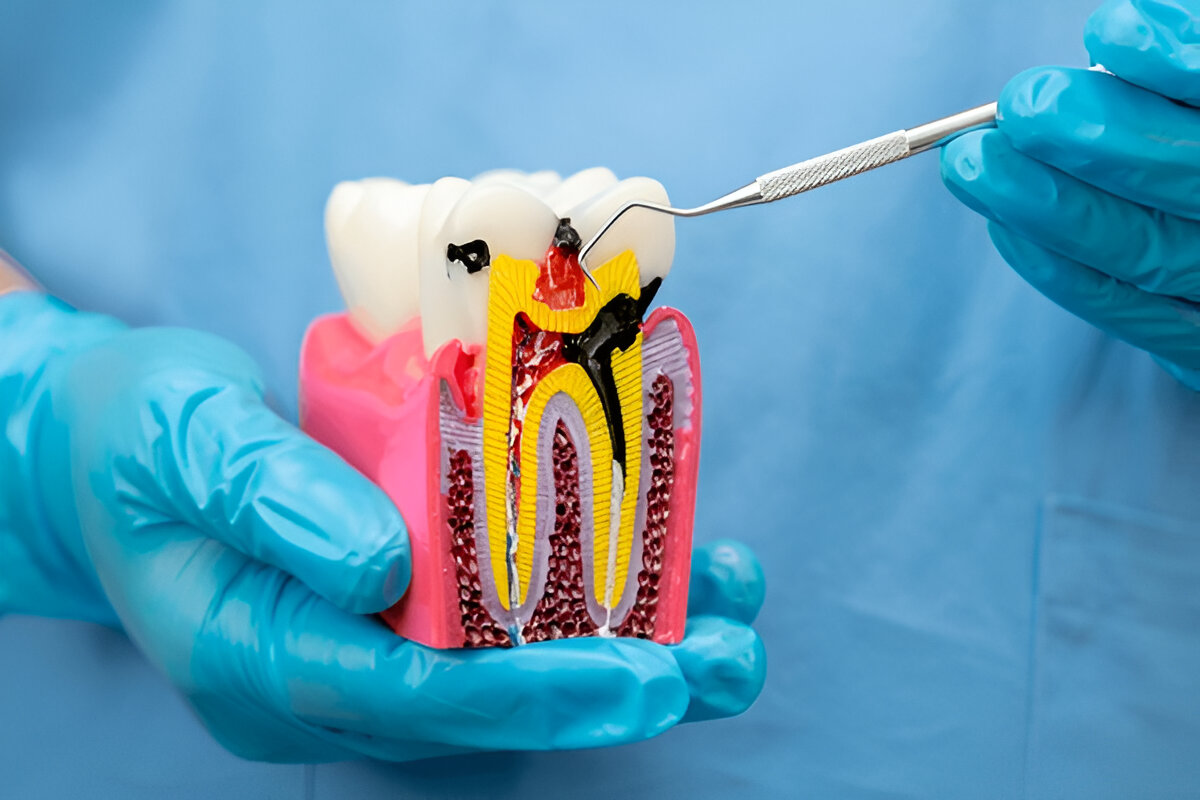 What is Root Canal Treatment?
