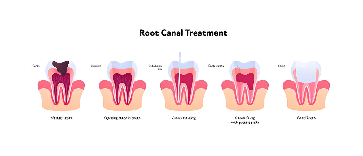 Who Needs Root Canal Treatment?