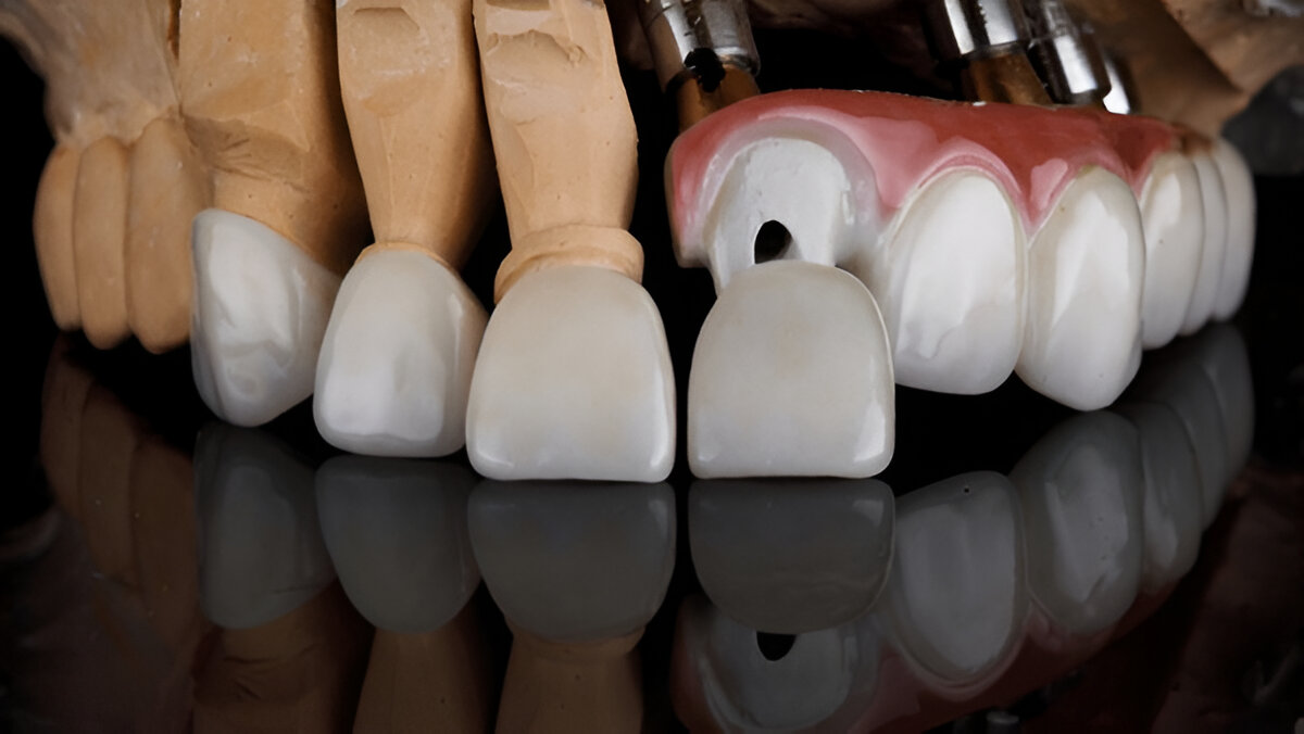 Dental Veneers