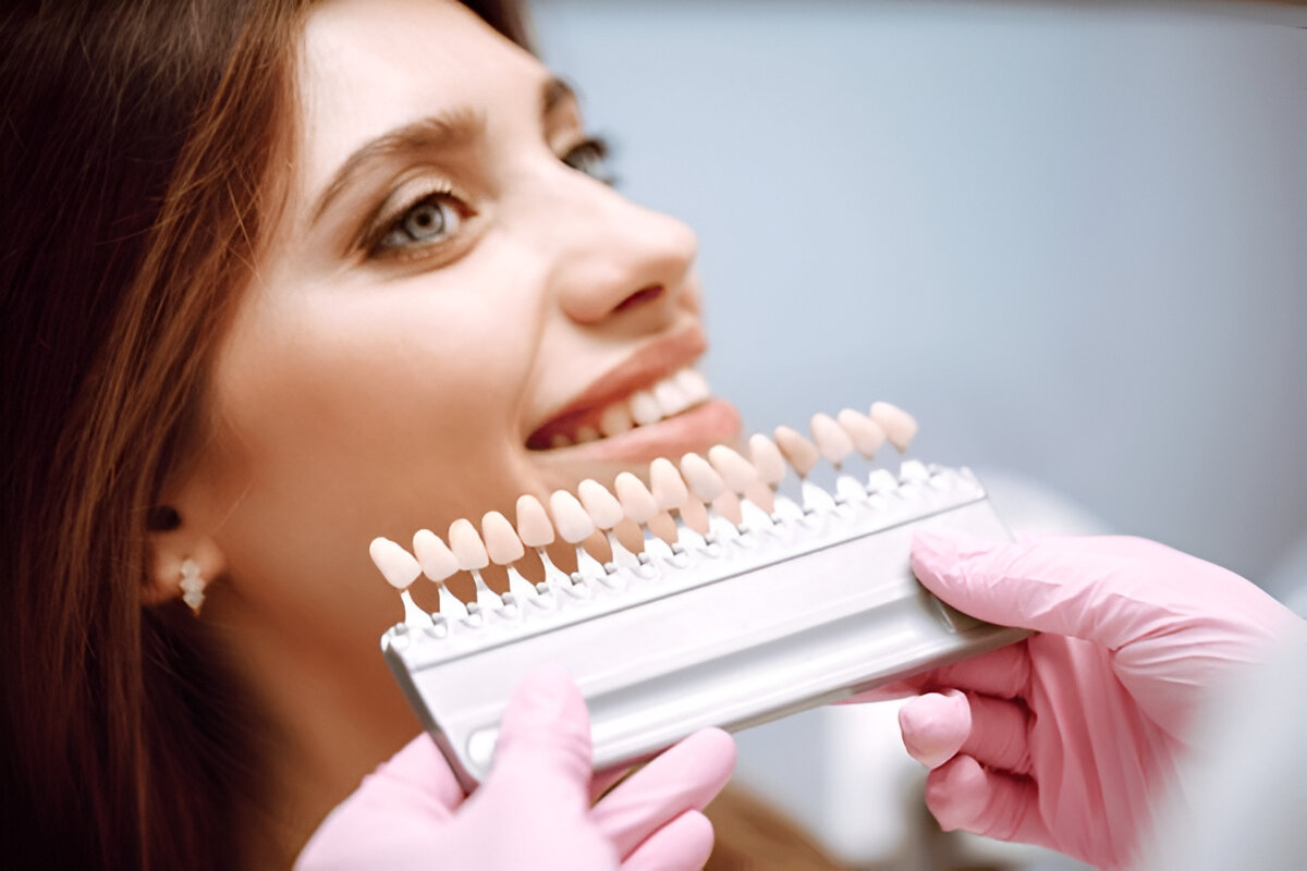 What Are Dental Veneers?
