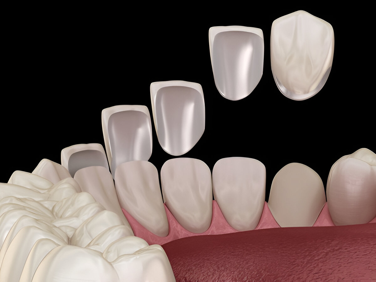 Benefits of Dental Veneers