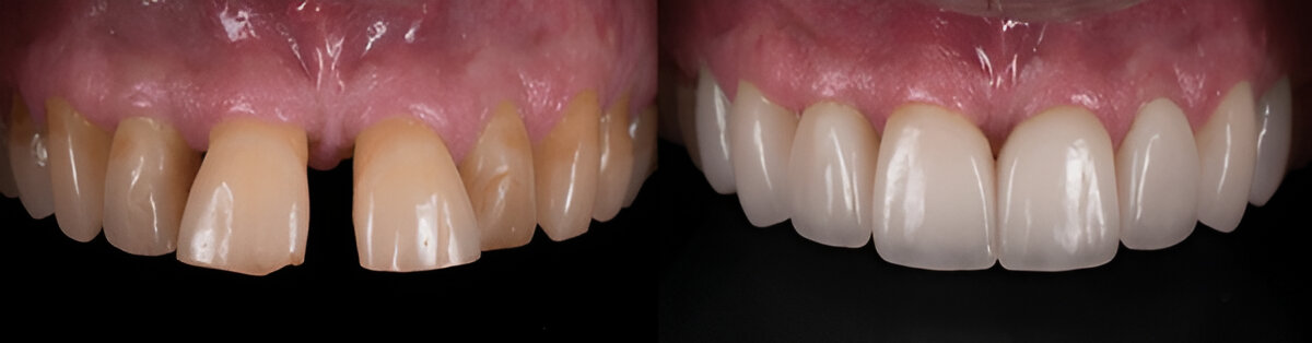 The Veneer Process
